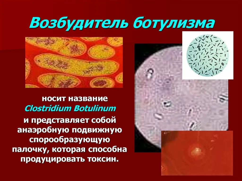 botulism4